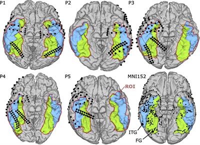 Multi-modal Mapping of the Face Selective Ventral Temporal Cortex–A Group Study With Clinical Implications for ECS, ECoG, and fMRI